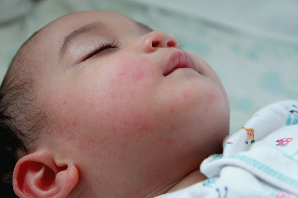 Eczema in babies, kids, and teens &#8211; Signs and management